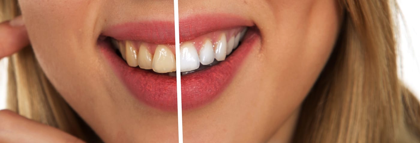Clareamento dental